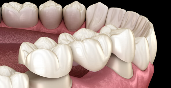 Teeth Whitening At Pienaar Health Dental Surgeons In Motueka Nelson NZ