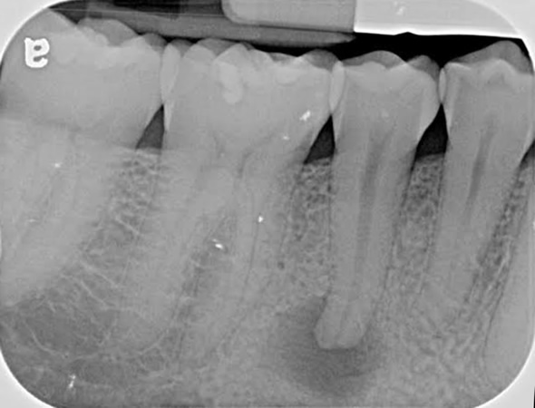 Treatment Of Abscess In Tooth At Pienaar Health Dental Surgeons In Motueka Nelson NZ