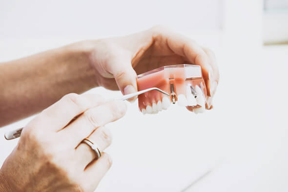 Dental Implants Service At Pienaar Health Dental Surgeons In Motueka Nelson NZ
